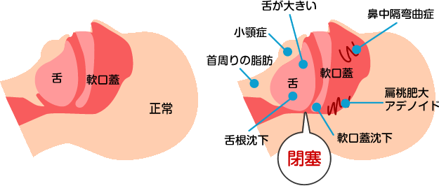 睡眠時無呼吸症候群